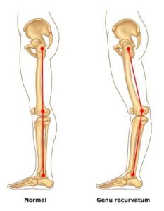 Joelho Valgo Varo Recurvatum Centro De Preserva O Articular Dr