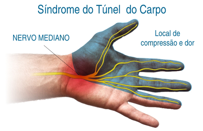 Síndrome túnel do carpo - Dr. Marcio Luiz Librelotto Rubin