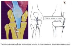 Medialização da Tuberosidade Anterior da Tíbia (TAT)