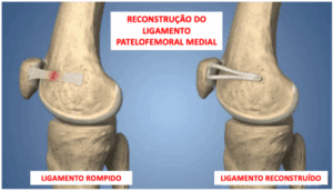 Reconstrução do Ligamento Femoro-Patelar Medial